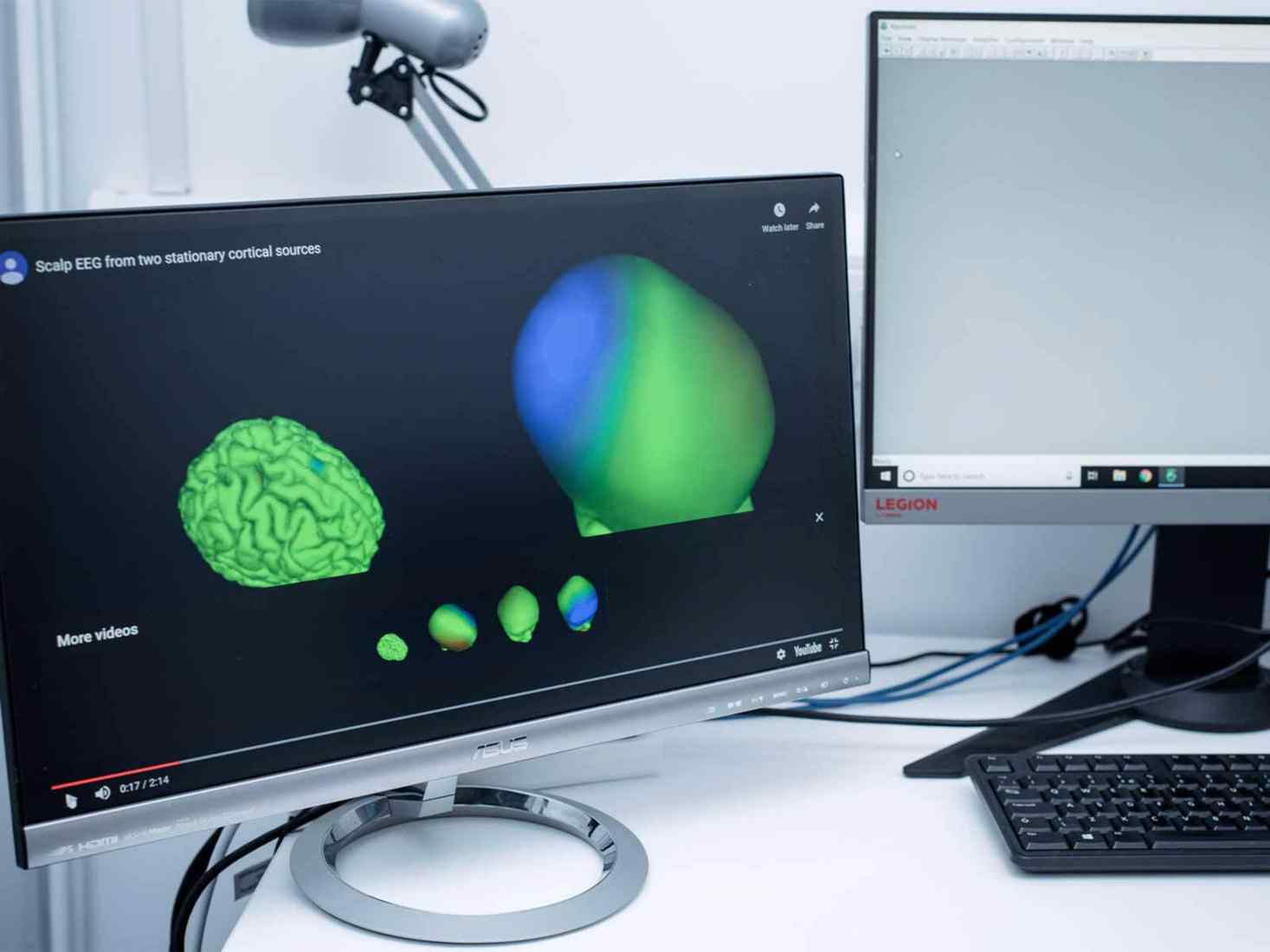 A computer screen showing a scan of a brain 
